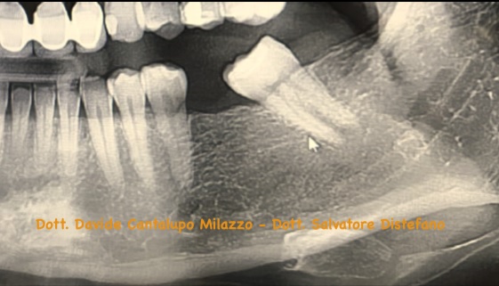 Ortodonzia preprotesica radiografia