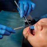 lesioni non cariose - dentista catania distefano